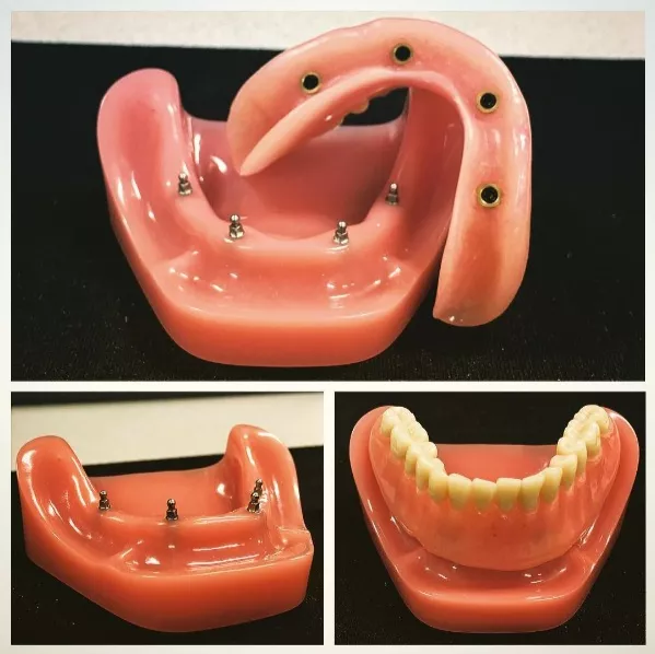 Mini Dental Implants
