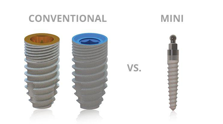 Mini Dental Implants