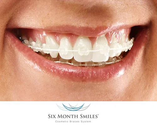 Invisalign - Virtually Invisible Braces