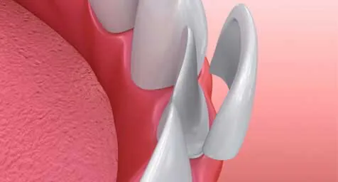 Dental Veneers in Novi, MI